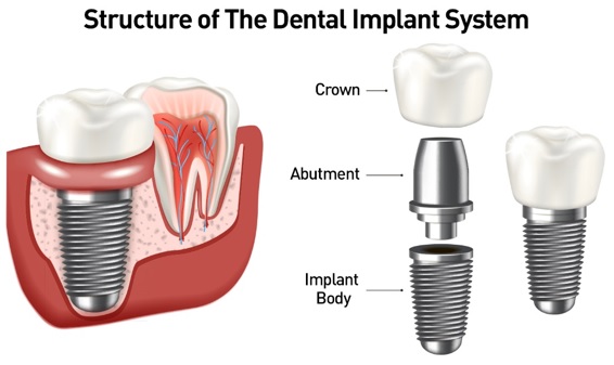 dental implant