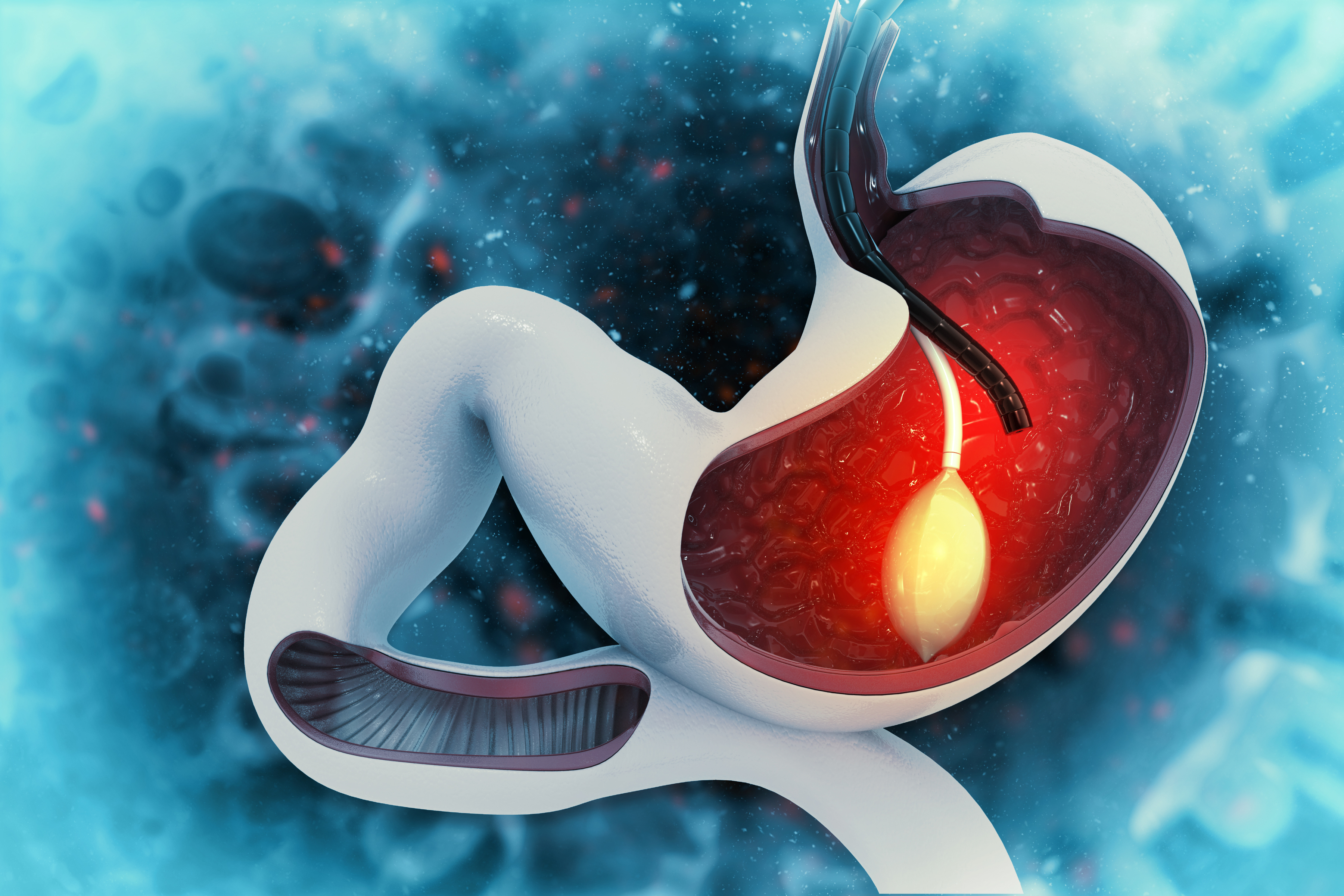 Gastric Balloon