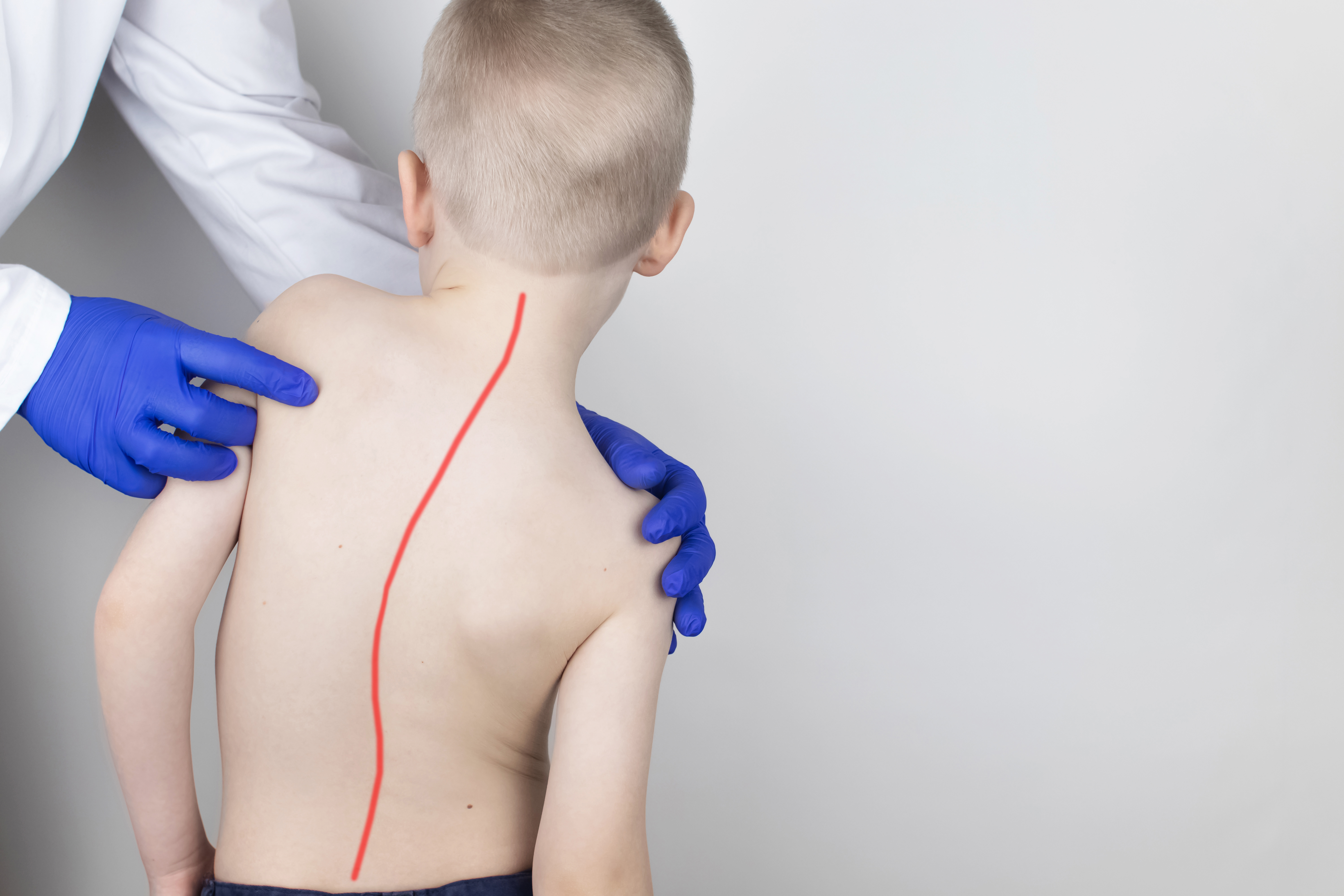 scoliosis surgery