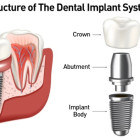 dental implant