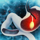 Gastric Balloon