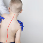 scoliosis surgery
