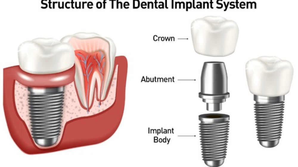dental implant