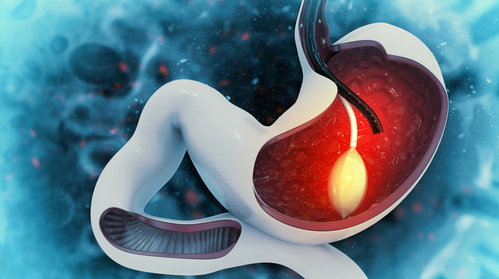 Gastric Balloon